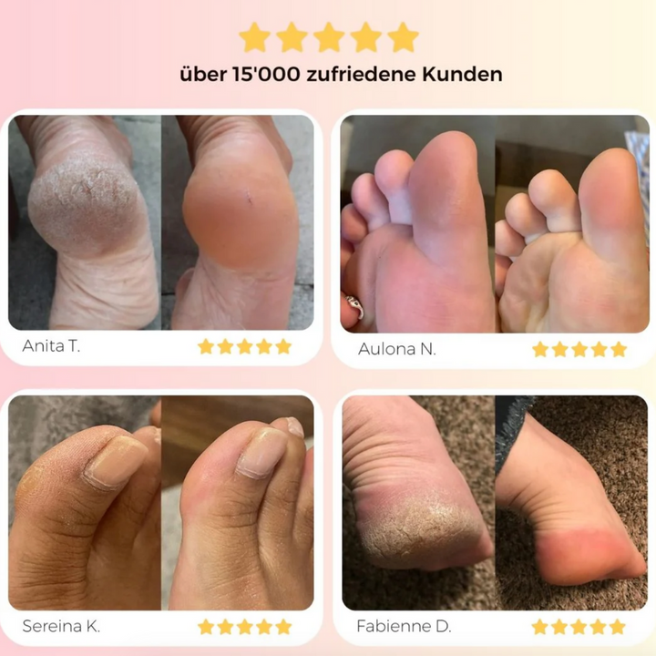 Babyfoot Pro - Elektrischer Hornhaut Entferner